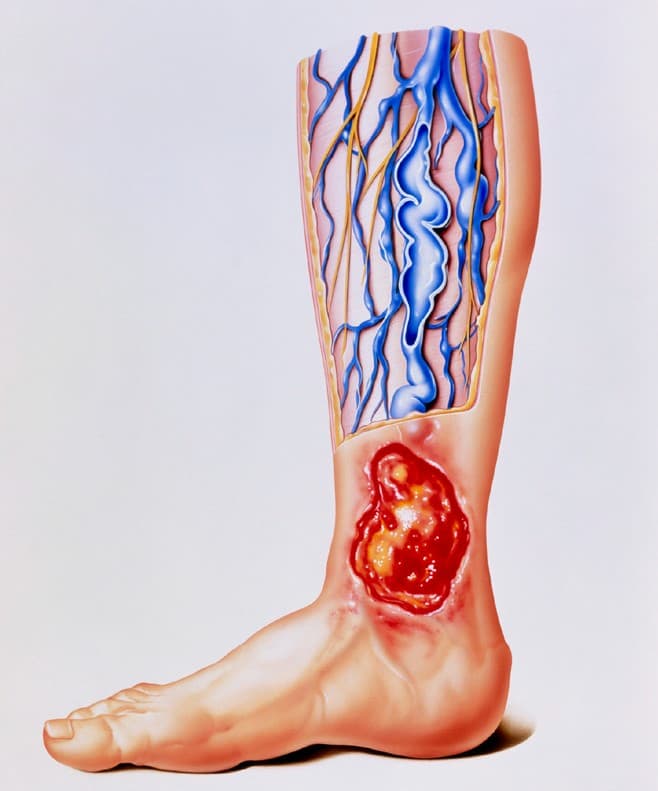 Ulcera en la pierna