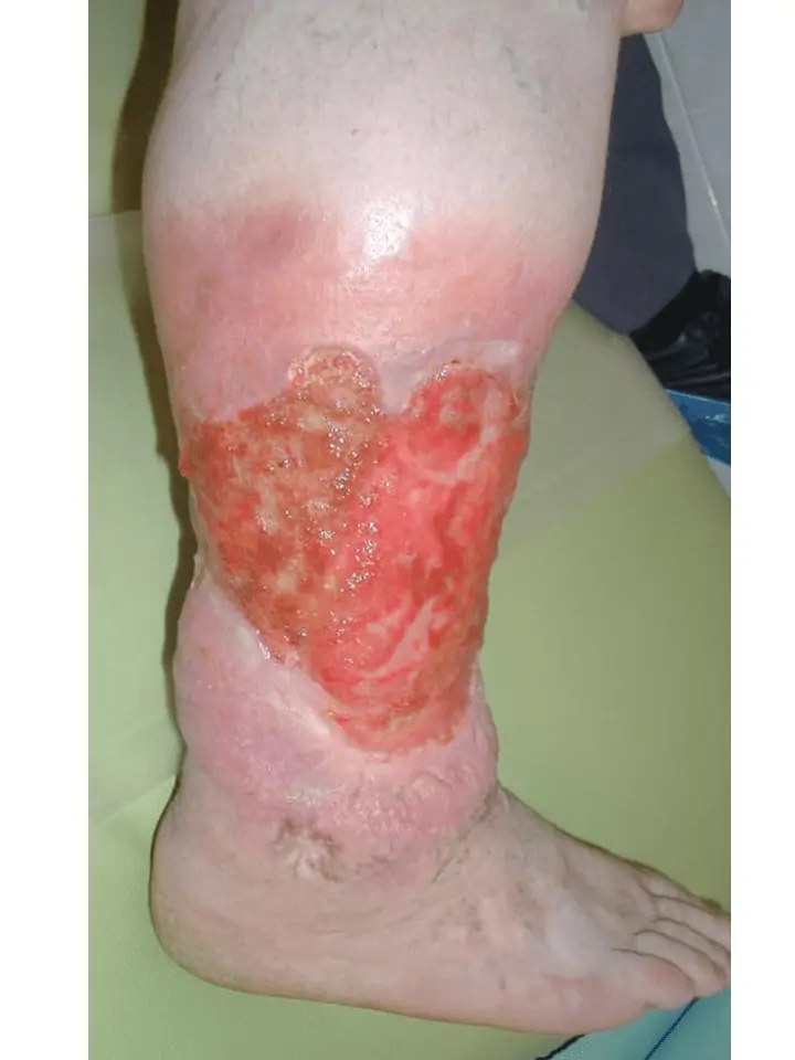 perna de perna varicoza ce sta etapa iniiala a varicozei